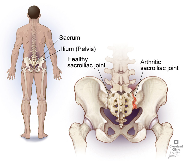 sacroiliac (SI) joint